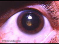 Congenital posterior polar cataract