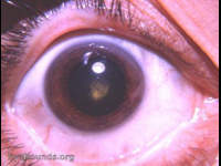 posterior polar cataract