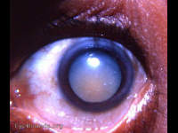 pre-Morgagnian cataract