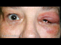 preseptal cellulitis