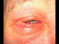 preseptal cellulitis from untreated hordeolum