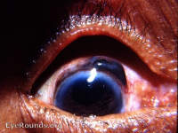 Iris Prolapse
