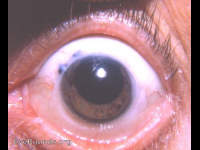 Intracapsular cataract extraction with complete iridectomy and iris prolapse