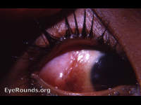 protuberant scar - reaction to lateral rectus muscle resection