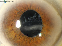 pseudoexfoliation syndrome