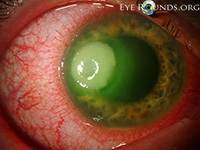 Pseudomonas keratitis