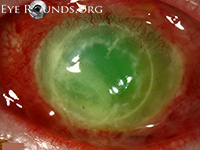 Pseudomonas keratitis
