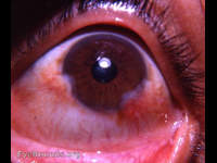 pseudopterygium / Salzmann's nodular corneal degeneration