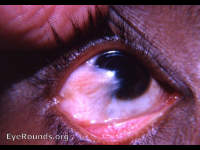 pseudopterygium