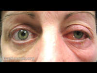 orbital pseudotumor