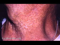 skin manifestation of Groenblad-Strandberg syndrome