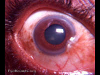 nasal pterygium, partial arcus senilis, and iridoschisis superiorly