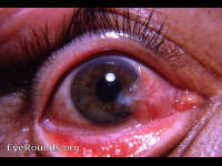 pterygium