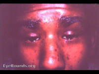 Bleparophimosis with ptosis