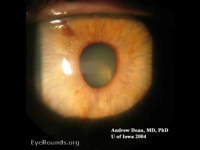 iridocorneal endothelial syndrome (ICE) early essential iris atrophy