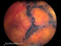 Stickler's syndrome (radial lattice)