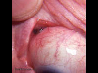 recurrent melanoma of conjunctiva