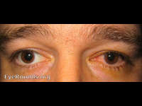 herpes simplex virus (keratitis) and iritis