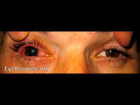 tuberculosis (TB) uveitis - iritis