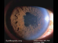 TB Uveitis