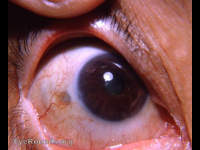 nodular scleritis: residual scleral thinning