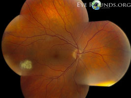 retinal astrocytic hamartomas
