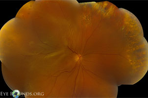 Retinal Breaks/Holes with Proliferative Vitreoretinopathy and Chronic Recurrent Rhegmatogenous Retinal Detachment