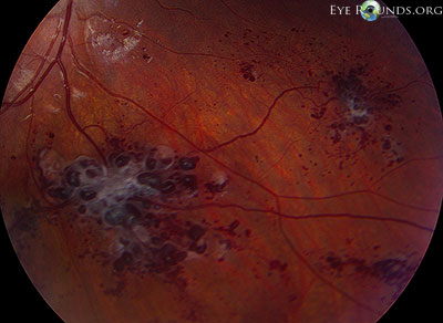 Retinal Cavernous Hemangiomas