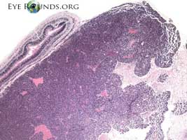 retinoblastoma, pathology/histology