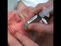 retrobulbar block before cataract surgery