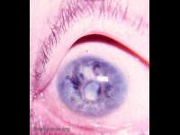pages/intracapsular-cataract-operation.html
