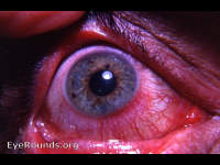 chronic blepharokeratoconjunctivitis associated with rosacea