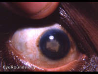 traumatic cataract