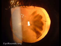 traumatic rosette cataract