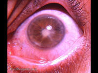rubeosis iridis, hyphema, iris atrophy, and cataracta complicata