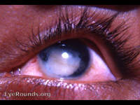 spontaneous rupture of cataracta complicata in an eye with chronic uveitis, iris atrophy, and neovascularization