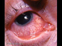 rust foreign body in cornea