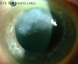 Salzmann Corneal Deneration