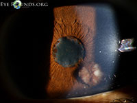 Sarcoid Uveitis