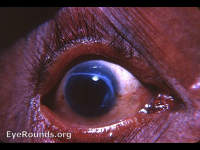 Improperly made von Graefe knife cataract incision