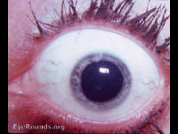 iridoschisis