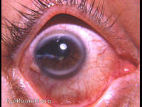 scissors perforation of cornea, adherent leukoma, arcus senilis, and prominent pinguecula