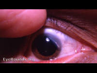 Scl;erosing Keratitis