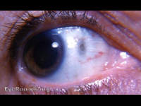 scleral hyaline plaque