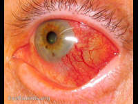 scleritis