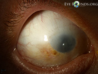 Sclerocornea