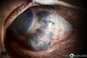 Scleromalacia and anterior staphyloma in the setting of congenital glaucoma