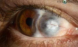 scleromalacia