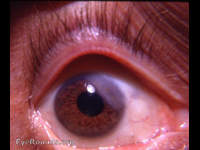 sclerosing keratitis