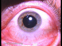 true-exfoliation of the anterior lens capsule
